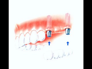 Crowns | Bridges | Dental | Abroad