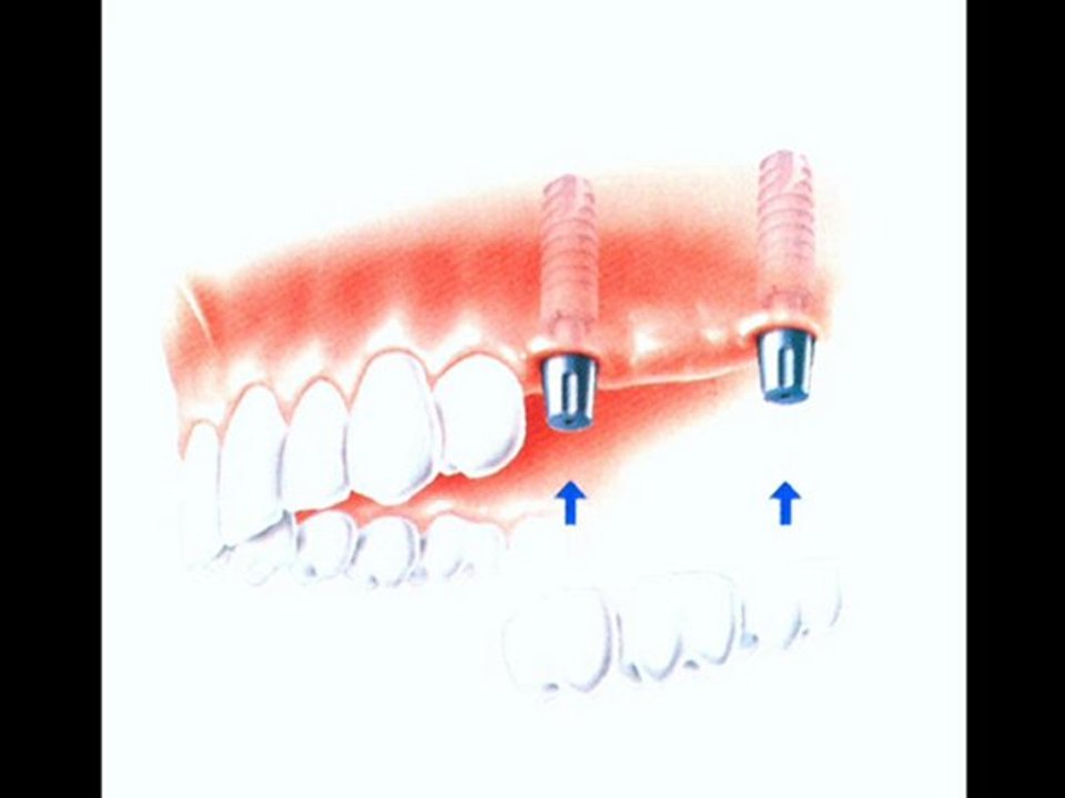 Kronen | Brücken | Implantatarbeiten | Ausland