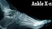 Ankle Sprain - Philadelphia, Norristown, PA – Podiatrist: Sprain Ankle Treatment