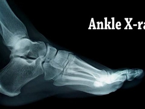 Ankle Sprain - Philadelphia, Norristown, PA – Podiatrist: Sprain Ankle Treatment