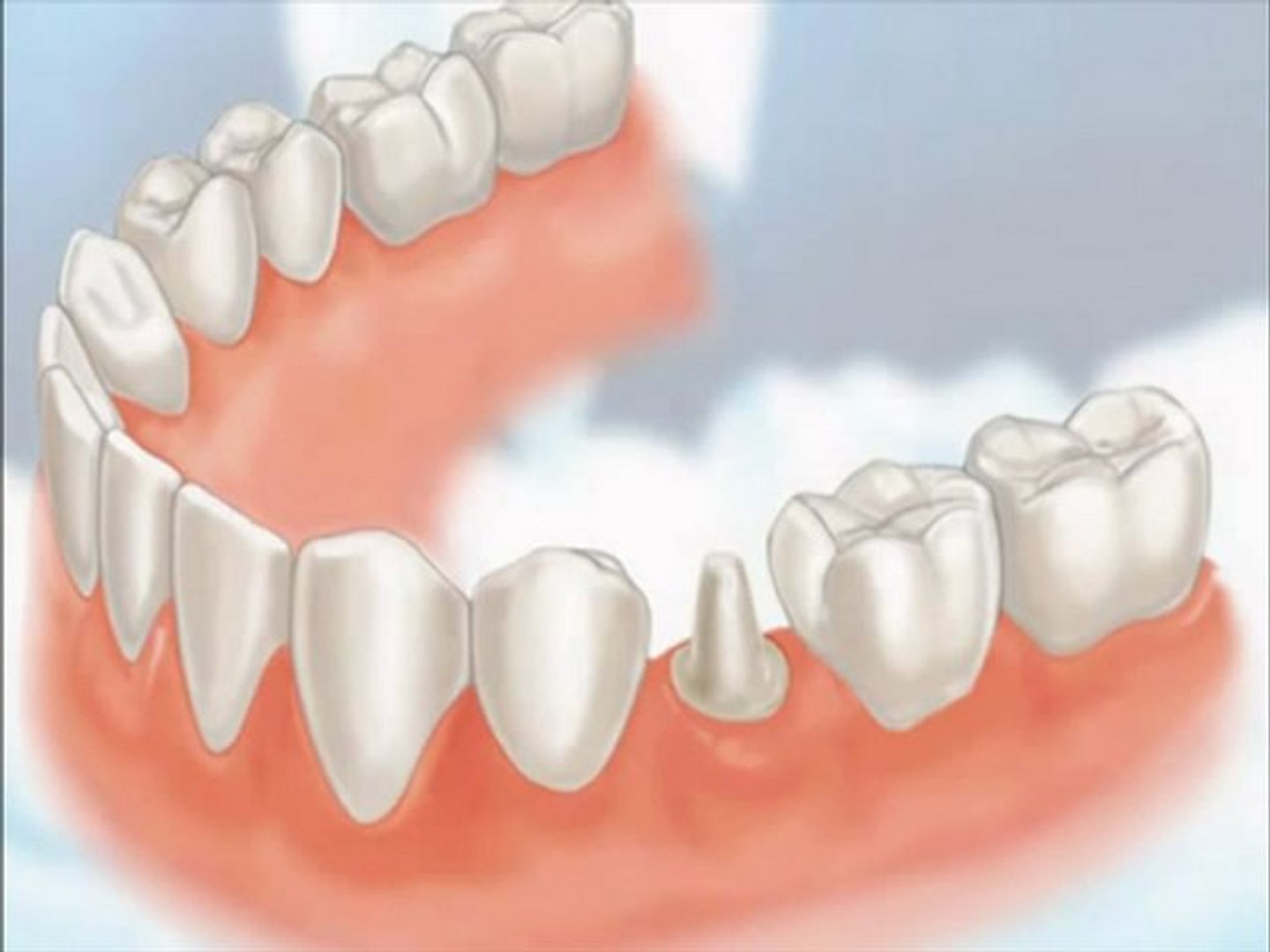 ⁣Dental Crowns Gurnee IL - Tooth Crowns Gurnee IL - Gurnee IL Porcelain Crowns