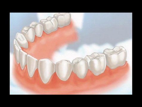 Dental Crowns Lake Bluff IL - Tooth Crowns Lake Bluff IL - Lake Bluff IL Porcelain Crowns