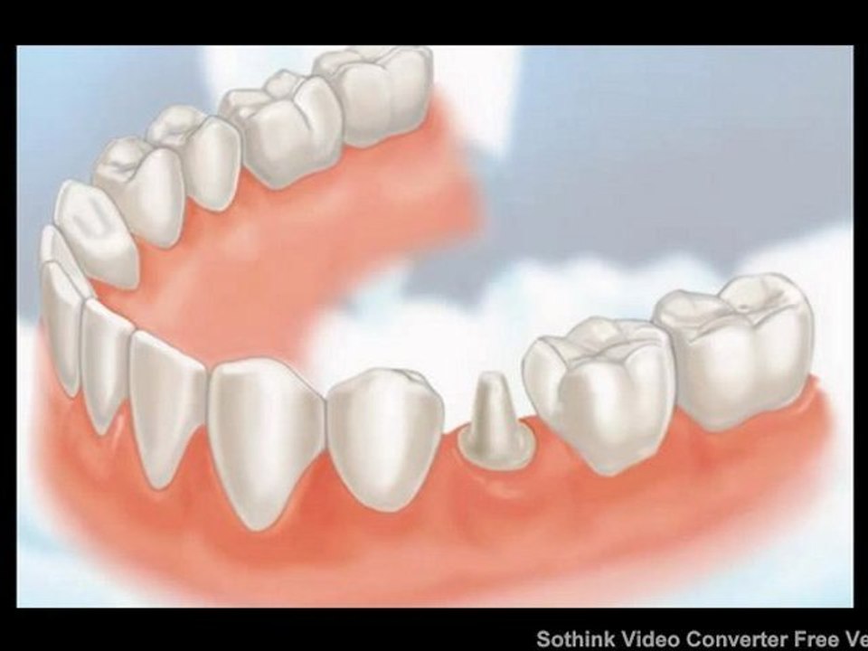 Dental Crowns Lake County IL - Tooth Crowns Lake County IL - Lake County IL Porcelain Crowns