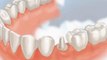 Dental Crowns Lake Forest IL - Tooth Crowns Lake Forest IL - Lake Forest IL Porcelain Crowns