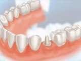 Dental Crowns Lake Forest IL - Tooth Crowns Lake Forest IL - Lake Forest IL Porcelain Crowns