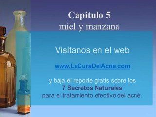 Tratamiento del acné Capitulo 5