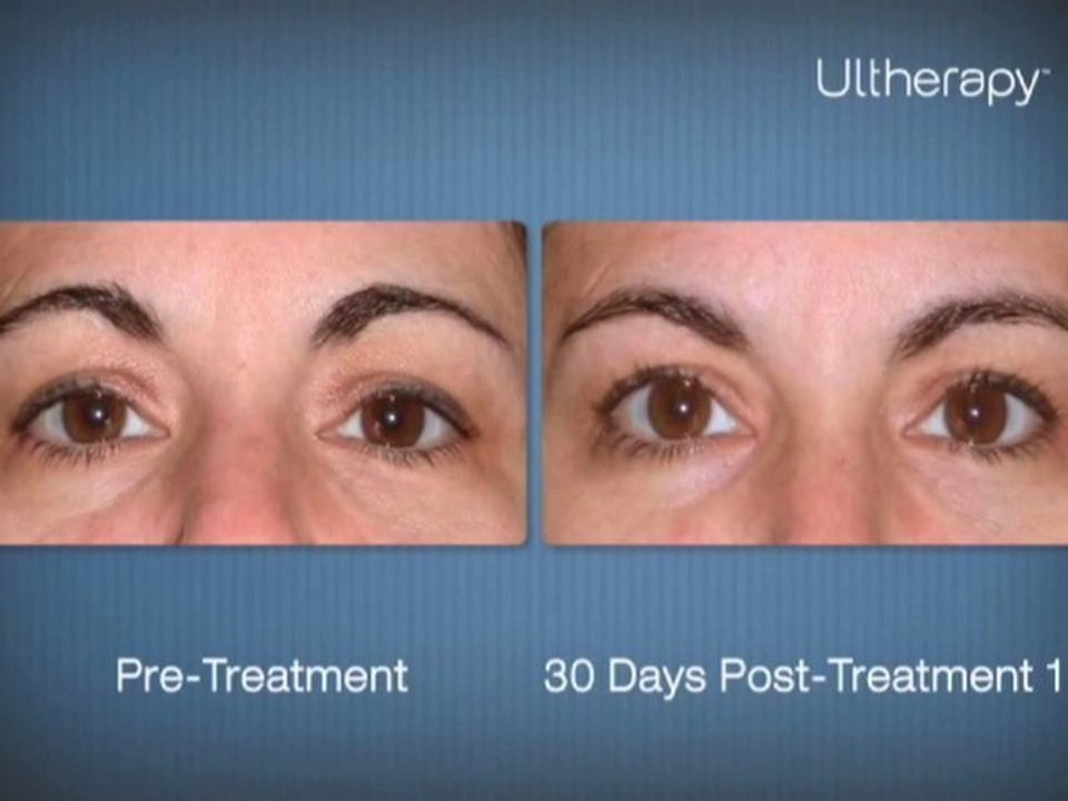 menopuase treatment beverly hills