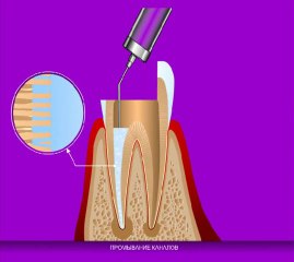_КолапАн. Лечение переодонтита.avi_‏ - YouTube