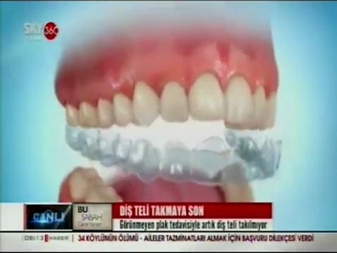 İlke Elgün Sky Turk 360 Diş Teli Takmaya Son