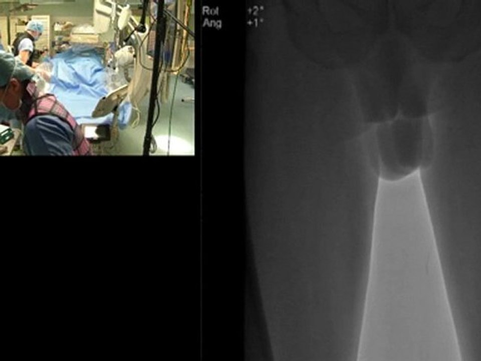 01 recanalization of right in-stent iliac occlusion. thrombo-atherectomy by rotarex - incathlab.com