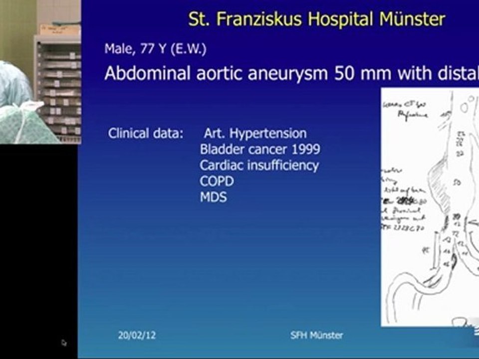04 short proximal neck without angulation. narrow distal neck. aorto-aortic tube incathlab.com