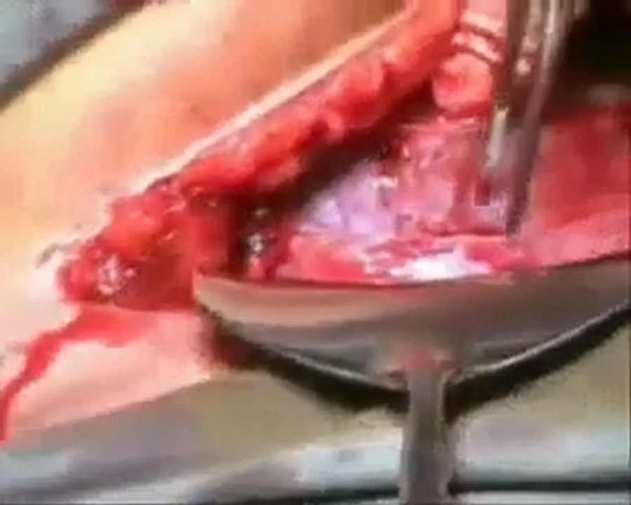 Sezeryan ile doğum  www.kumanda.org