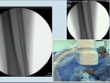 18 btk recanalisation et stenting du tronc tibio-peronier gauche-debut du live case incathlab.com