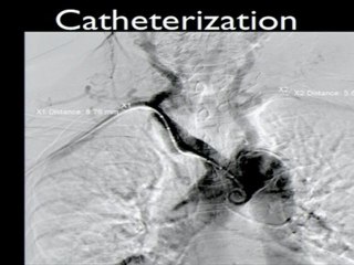 21 LAD PCI before tavi procedure radial approach incathlab.com