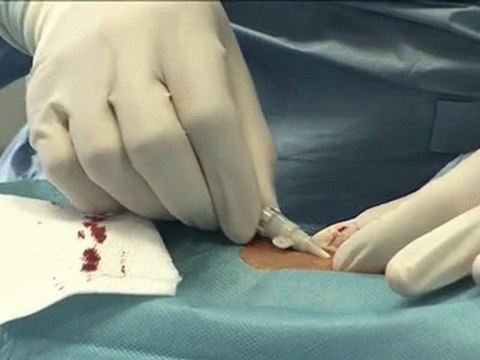 22 complex RCA remodeling with rotablator radial approach incathlab.com