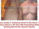 Stretch Marks Pregnancy Remedies