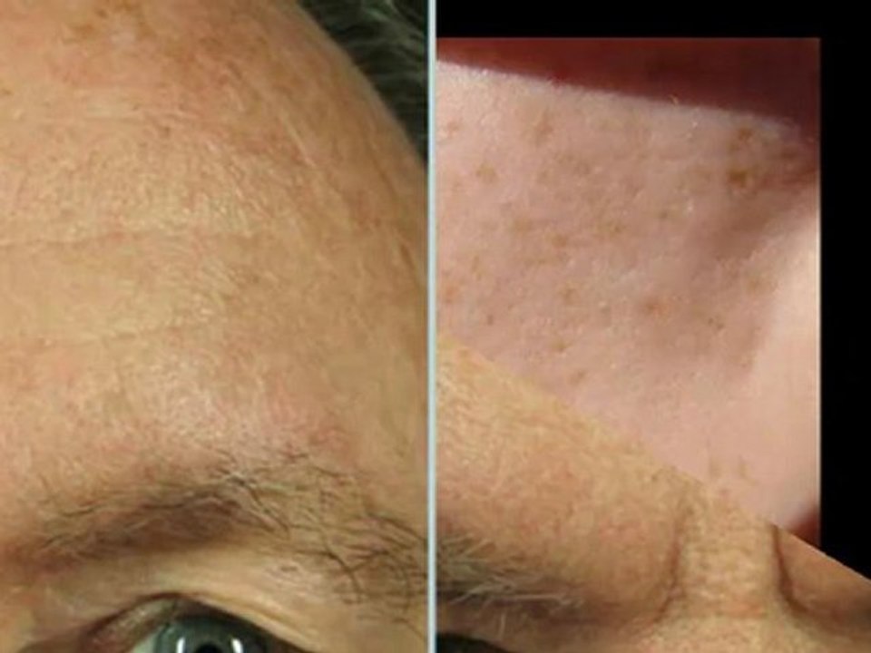 Types of Brown Spots--[ The Skin Problem]