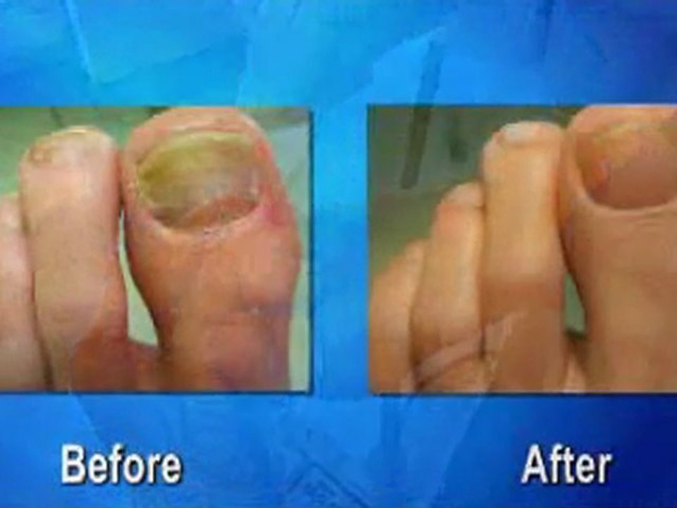 Laser Fungal Toenails - Toronto - Podiatrist, foot Doctor of Podiatric Medicine, Foot Specialist