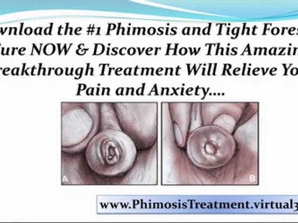 phimosis treatment - tight phimosis - phimosis cures