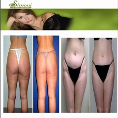Make Changes in Your Overall Personality With Smart Lipo Treatment