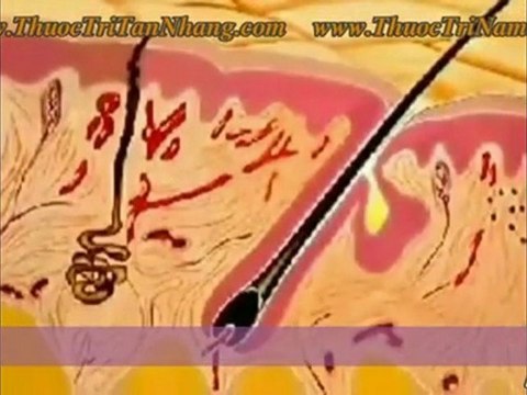 Điều trị nám tan nhang hiệu quả phần 5