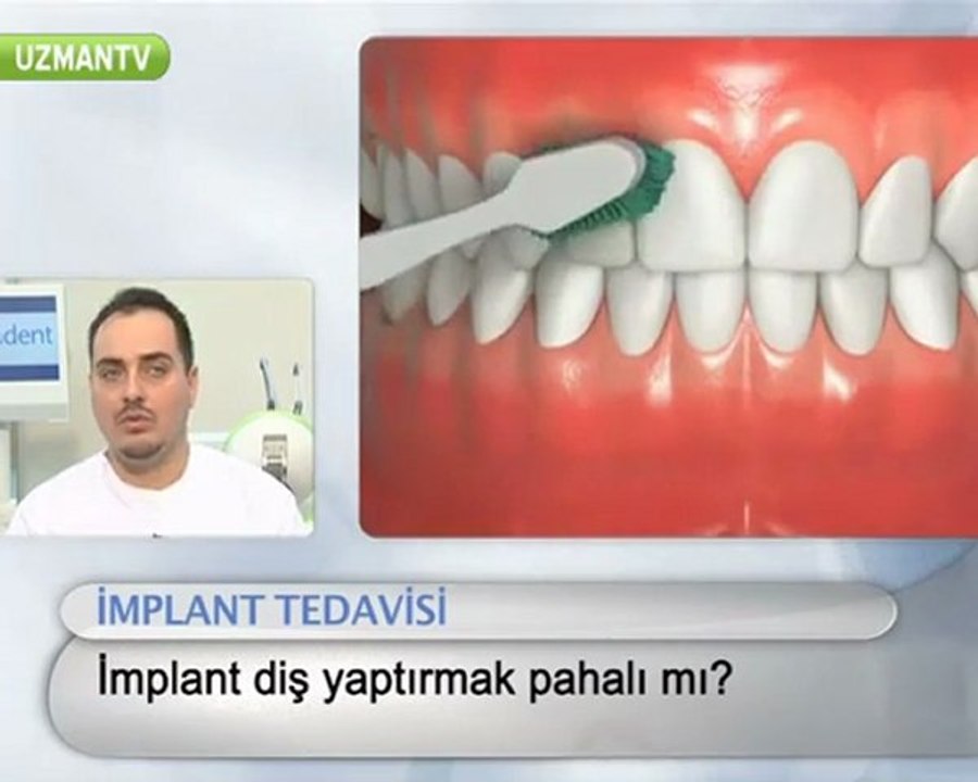 İmplant,çakma diş pahalı mıdır?-Serkan Tüzün