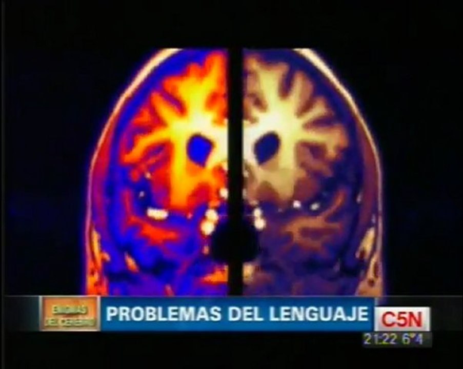 Afasias: Cerebro y lenguaje