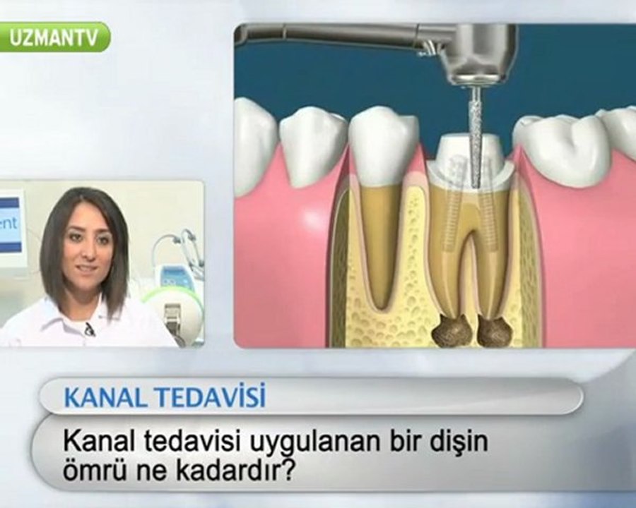 Kanal tedavisi ne kadar süre gider?-Miray Uyan