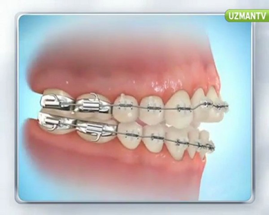 Diş teli kullanmadan ortodontik  tedavi yapılabilir mi?-İlke Elgün