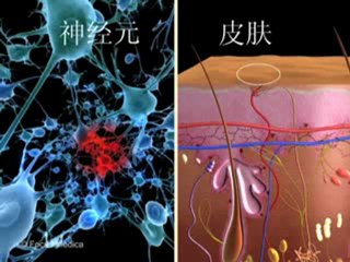 Hypertension Medical Animation