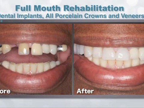 Smile Makeover in Orange County - Andrew G. Mortensen D.D.S.