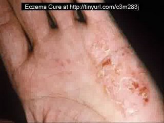 Eczema Cures for Babies