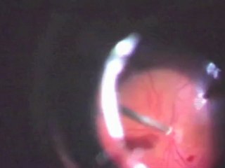 A New Macular Hole Closure Technique Marzio Chizzolini