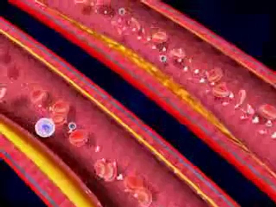 Medical Animation Explains Strokes
