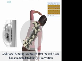 ApiFix Less Invasive Scoliosis Correction System