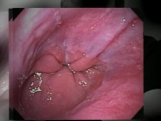 Eosinophilic Esophagitis and Difficulty Swallowing