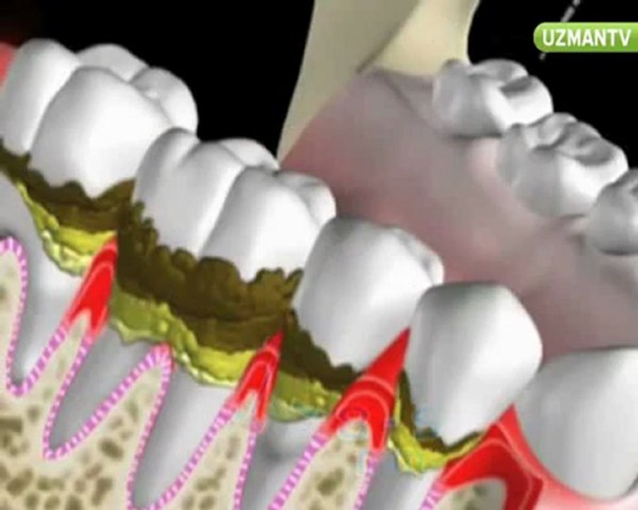 Dr. Nihat Tanfer - Çene kistleri tedavi edilmezse ne olur-
