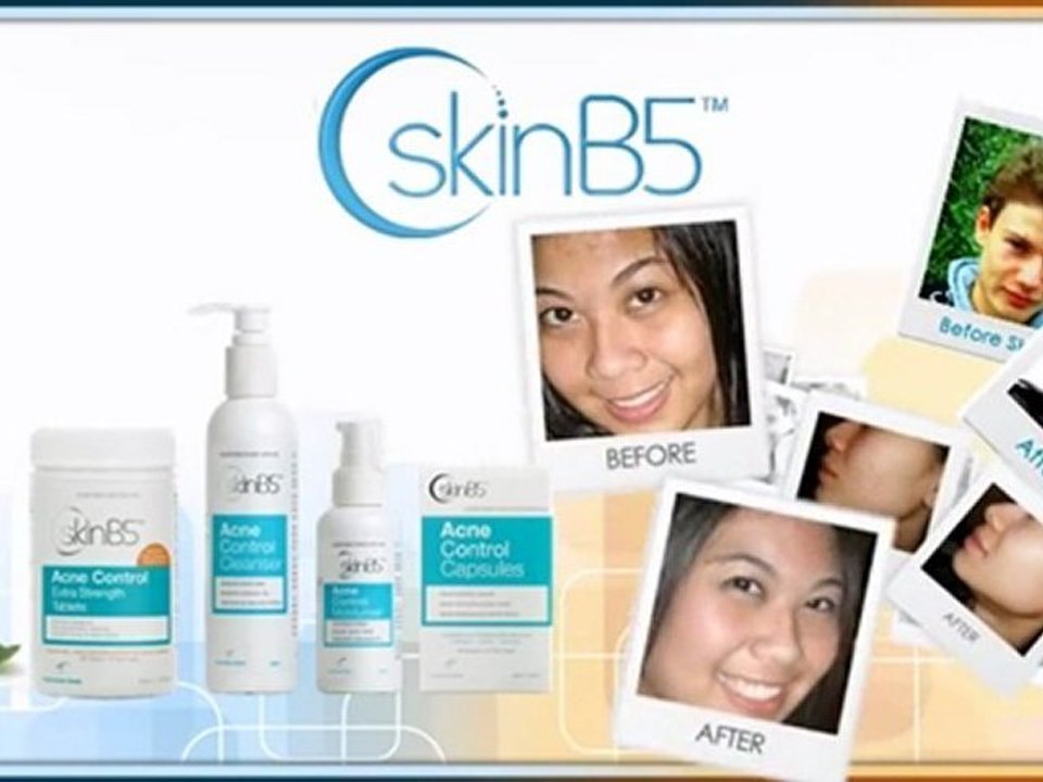 Pimples, Vitamin B5, Acne Cures, Acne Vitamins, Best Acne Treatment, Acne, Cure For Acne