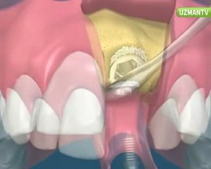 Dr. Nihat Tanfer - İmplant dişler doğal görünür mü-