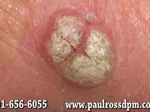 Foot Warts (Plantar Warts) - Podiatrist in Bethesda, MD and Springfield, VA