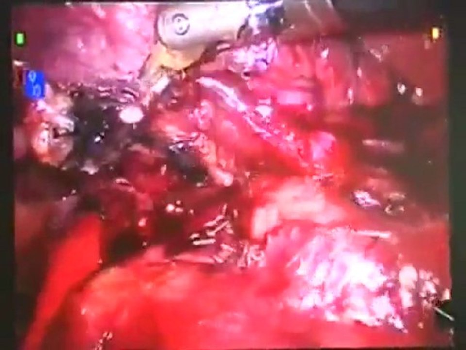 Robotic Surgery: Lung Surgery with the daVinci Robotic System