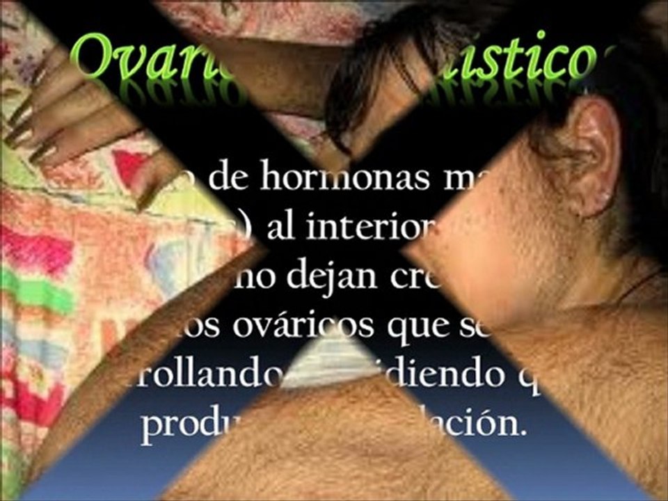 Ovarios Poliquisticos / Eliminar Quistes de Ovarios