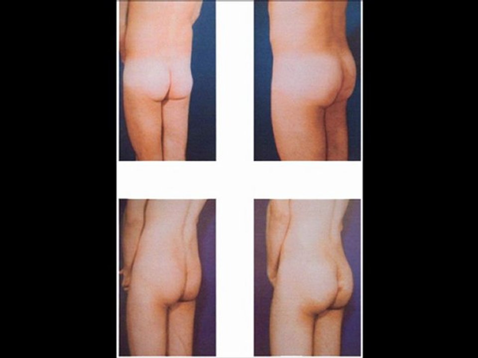 implantes en los gluteos