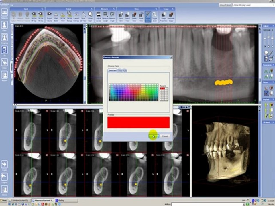 Planificacion de implante, Etapa 2 Marque el nervio