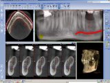 Planificacion de implante, Etapa 3 Colocación del implante