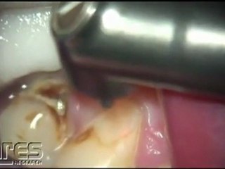 Class V Laser Cavity Prep w Gingivectomy, Tipless Handpiece  Lares PowerLase AT Laser Dentistry