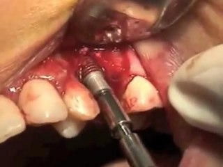 internal sinus lift with Easy Graft.m4v