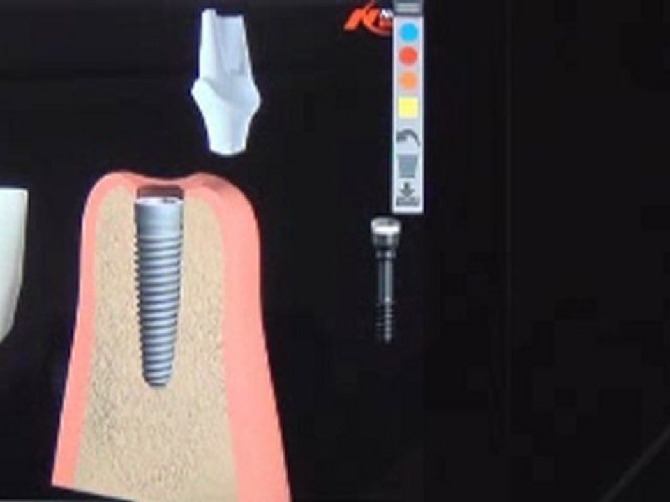 Immediate Dental Implant