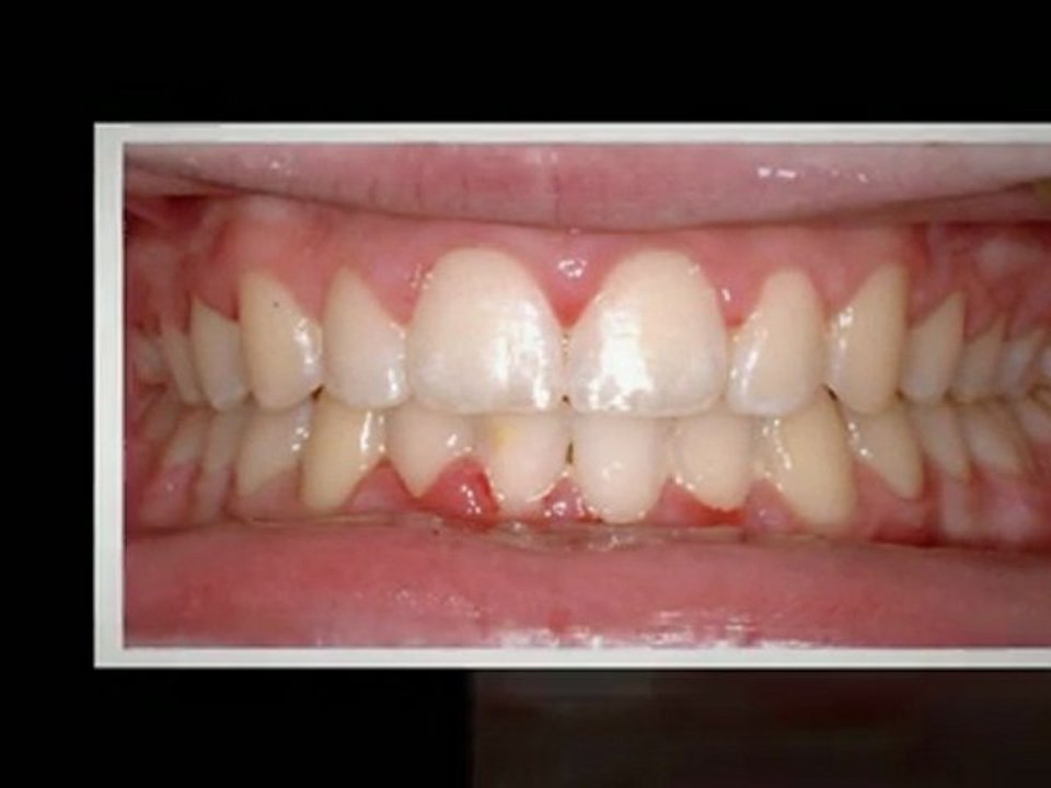 Westminster Braces Mar2012