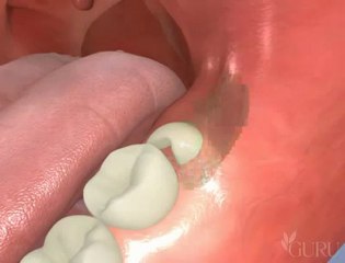 Extraction de dent de sagesse